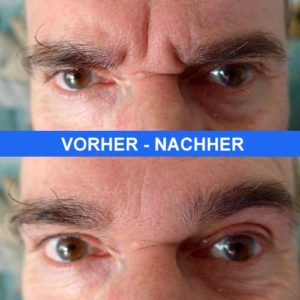 Zornesfalte vorher-nachher